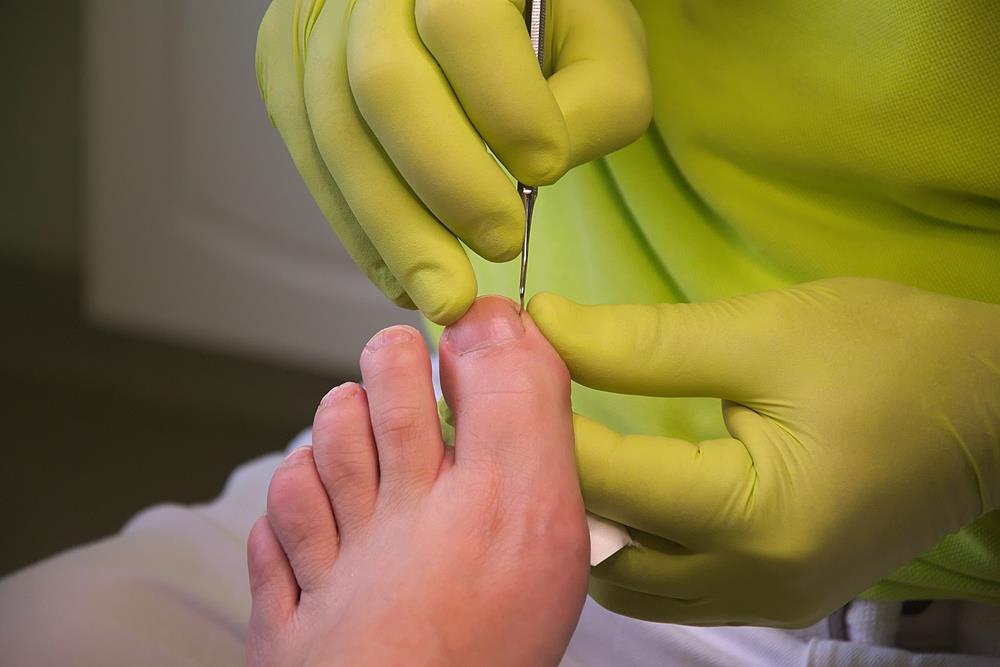 Ingrown Toenails  Lyndhurst, OH 